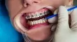 چگونه کودک را برای انجام ارتودنسی آماده کنیم؟