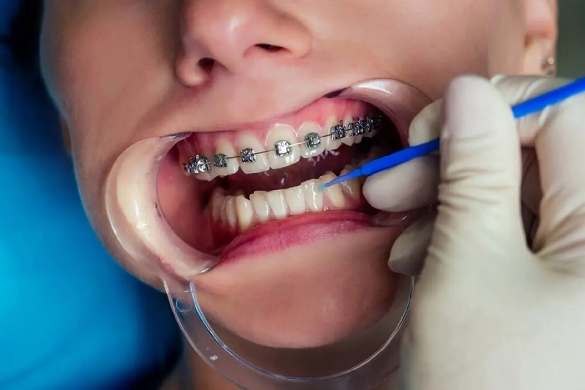 چگونه کودک را برای انجام ارتودنسی آماده کنیم؟