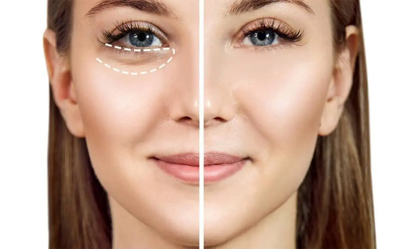 پف زیر چشم به خاطر کمبود کدام ویتامین است؟