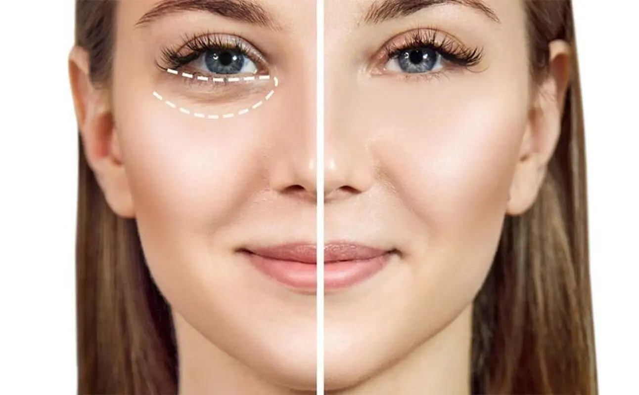 پف زیر چشم به خاطر کمبود کدام ویتامین است؟