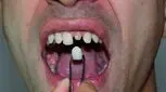 روکش دندان چیست و چه انواعی دارد؟