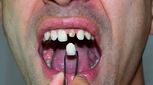 روکش دندان چیست؟ + هزینه روکش دندان در ایران (سال 1403)