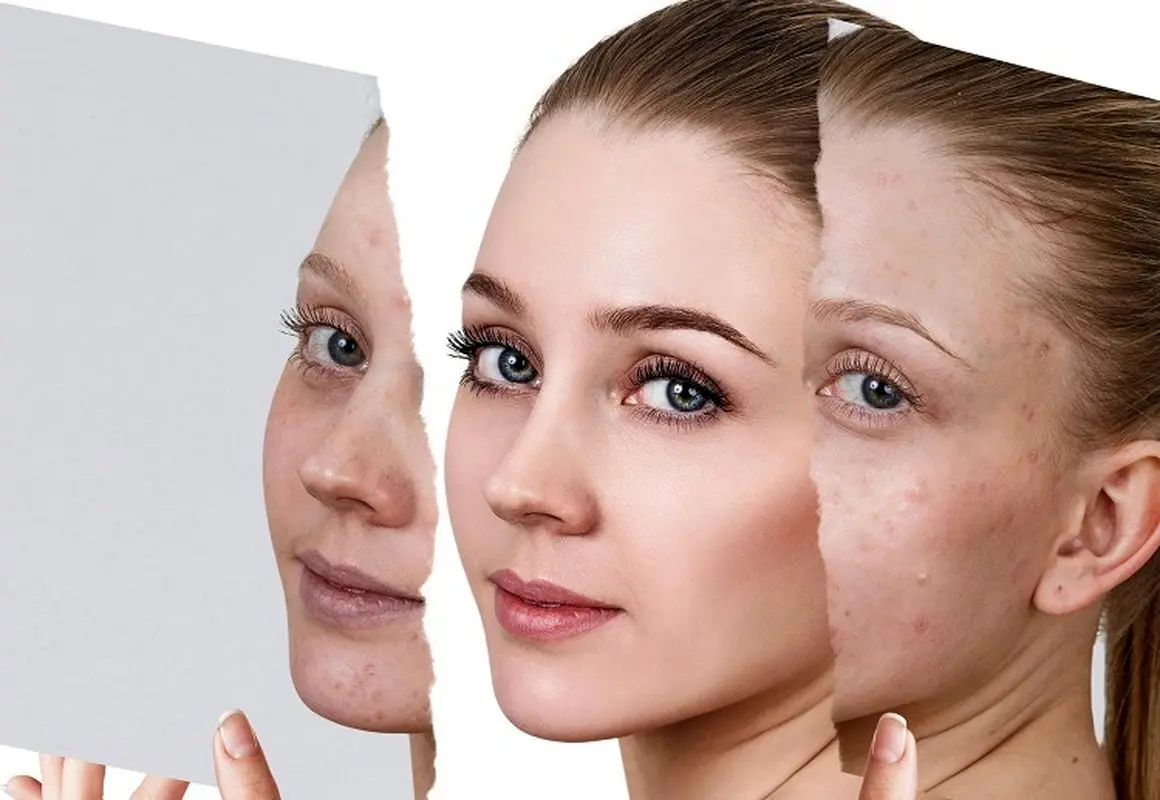 پانچ صورت برای درمان جای جوش و اسکار آکنه