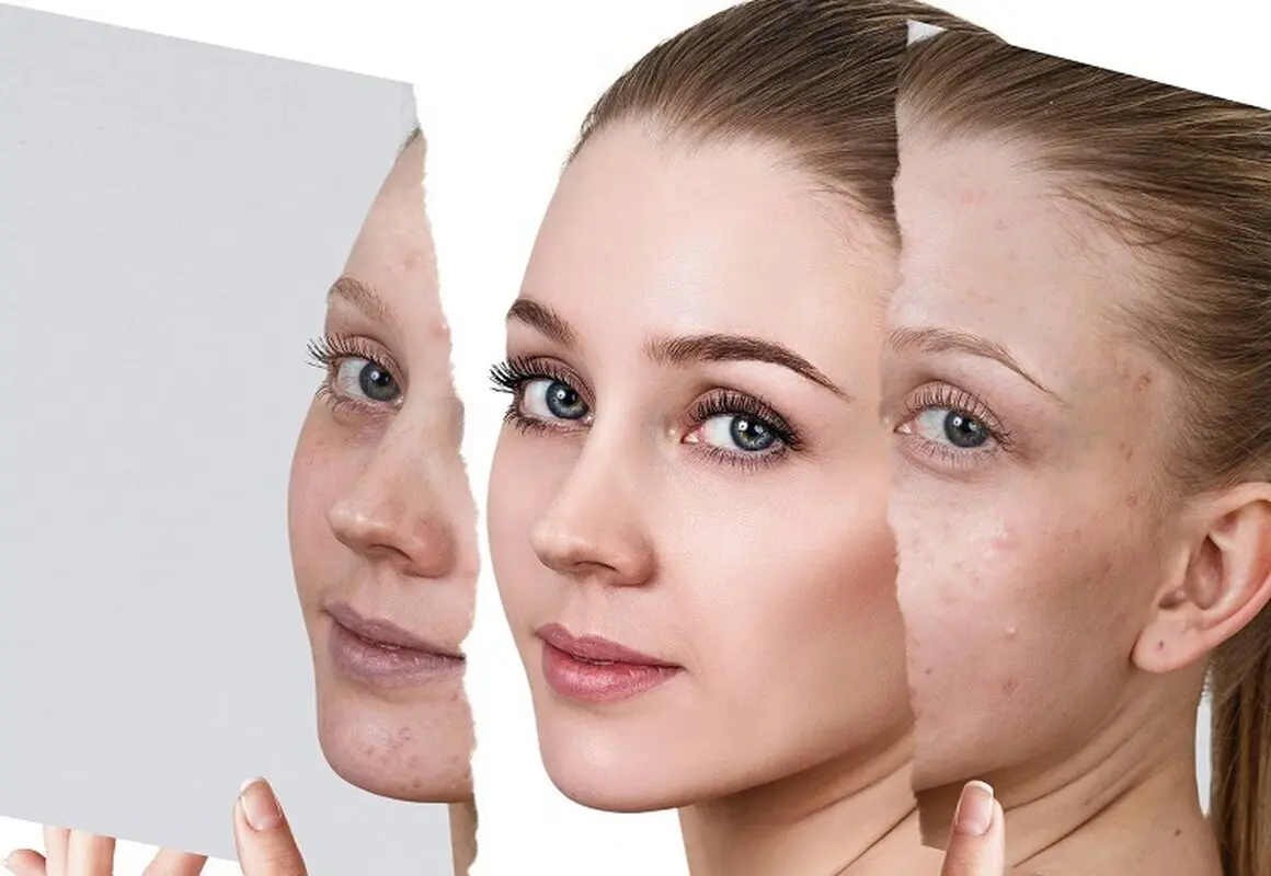 پانچ صورت برای درمان جای جوش و اسکار آکنه