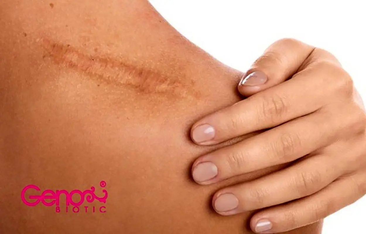 استفاده از کرم ترمیم‌کننده، ساده‌ترین راه برای بهبود جای زخم