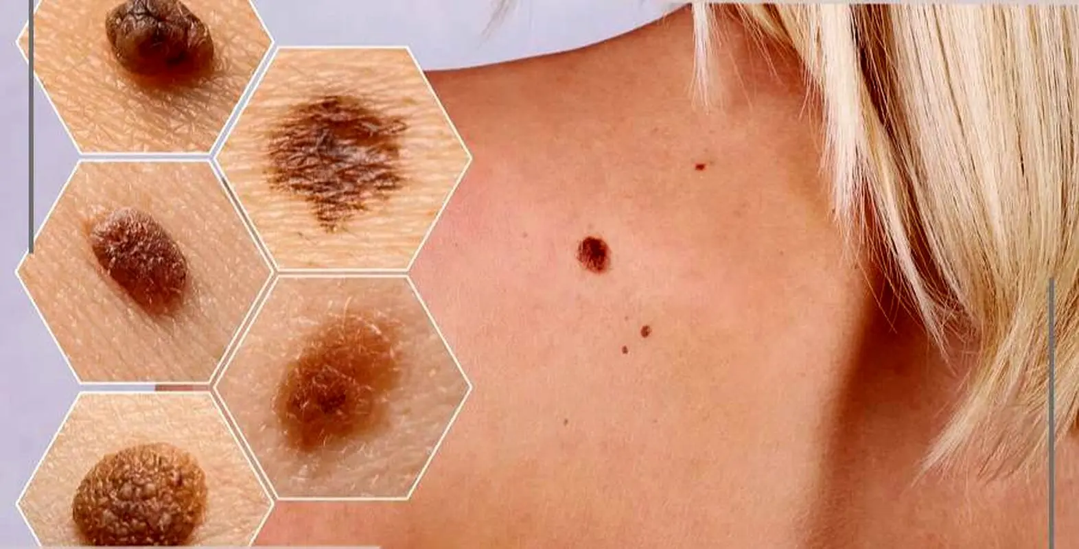 سرطان پوست سنگفرشی چیست؟/ پیشگیری، علائم و درمان 

