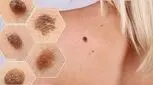 سرطان پوست سنگفرشی چیست؟/ پیشگیری، علائم و درمان 

