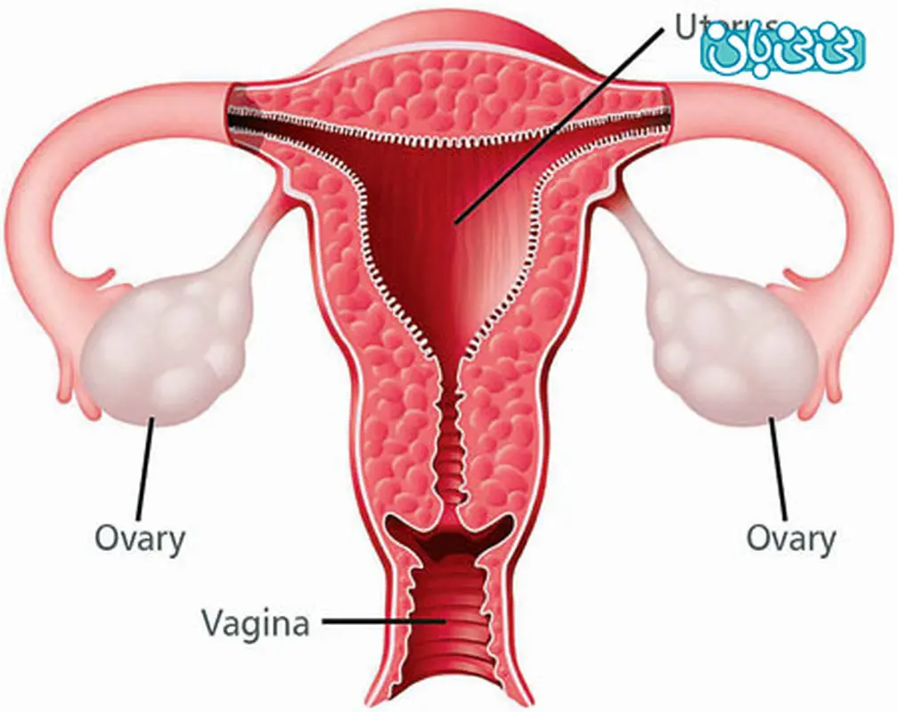 علائم سرطان تخمدان (1)