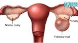 با کیست تخمدان می توان بچه دار شد؟