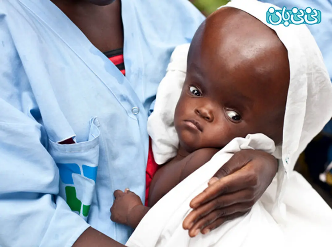 هیدروسفالی نوزاد چیست؟