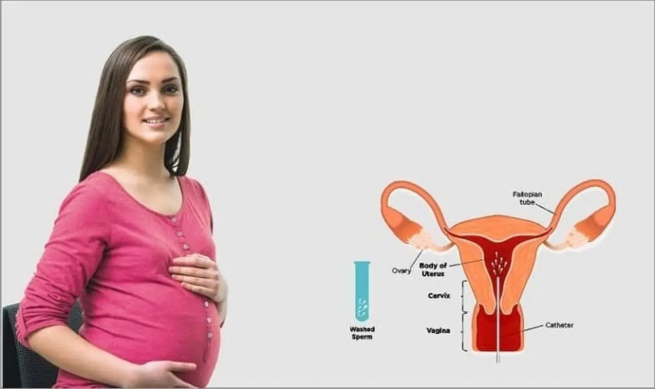 درمان نازایی با IUI (آی یو آی)