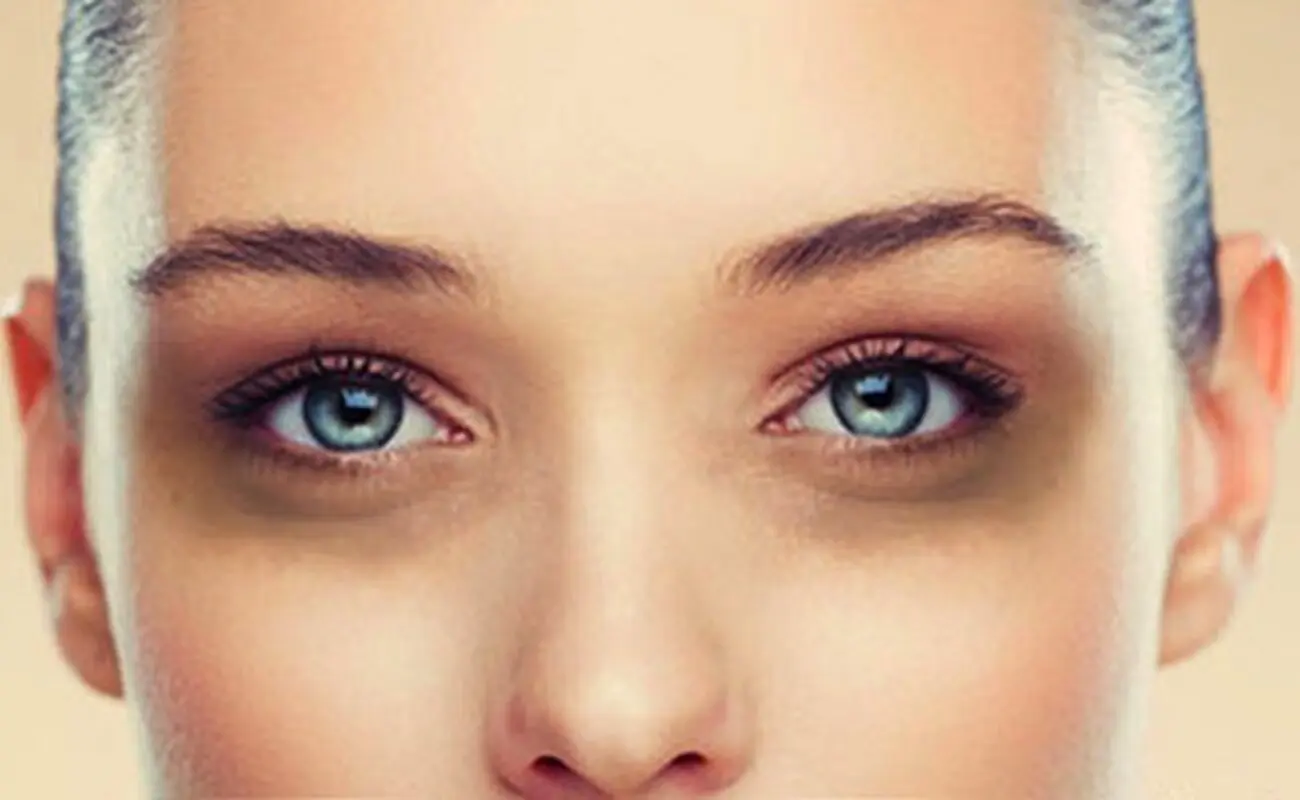 چرا زیر چشمها سیاه میشود؟