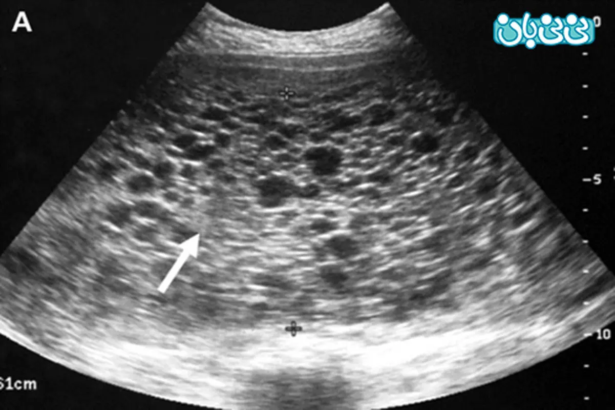 علت حاملگی پوچ یا حاملگی بدون جنین چیست؟