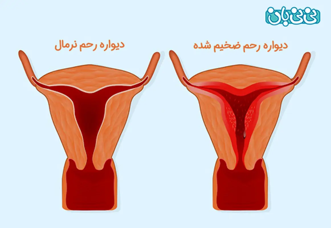 نازک شدن دیواره رحم و اثرات آن بر بارداری