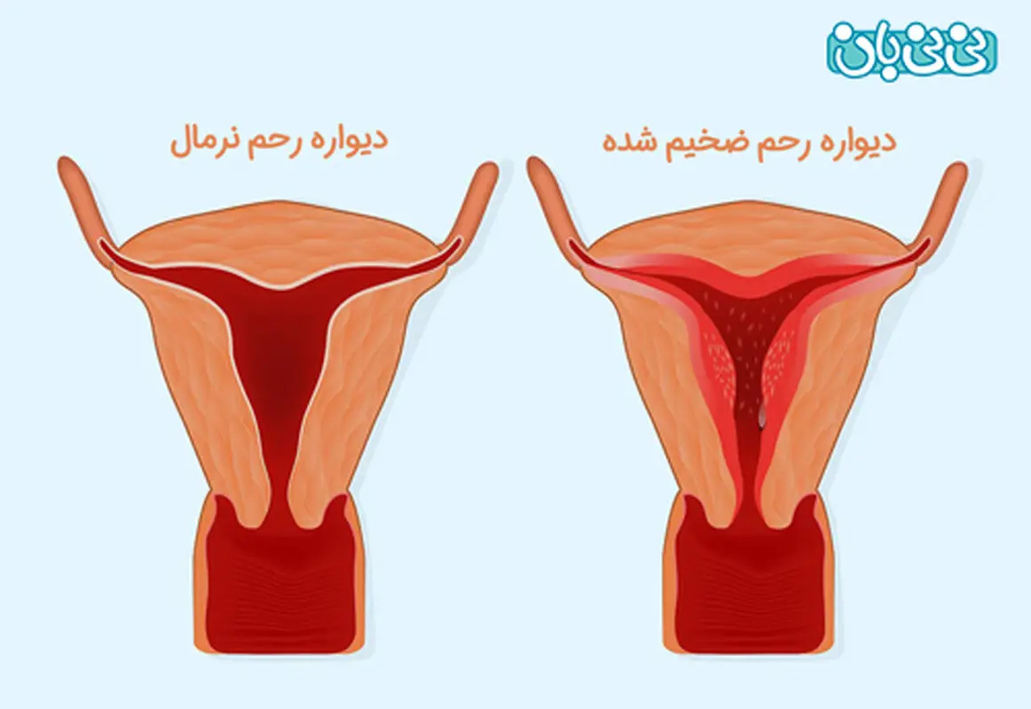 نازک شدن دیواره رحم و اثرات آن بر بارداری