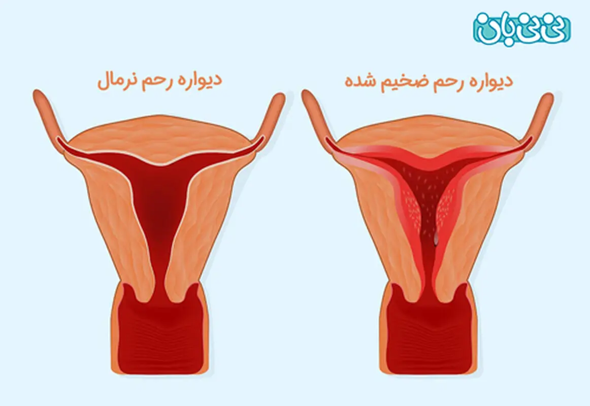 نازک شدن دیواره رحم و اثرات آن بر بارداری