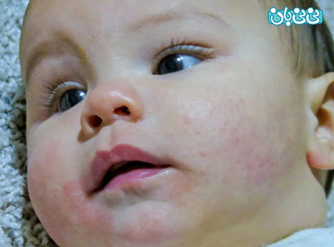 لکه های قرمز پوست کودک، اگزما است؟