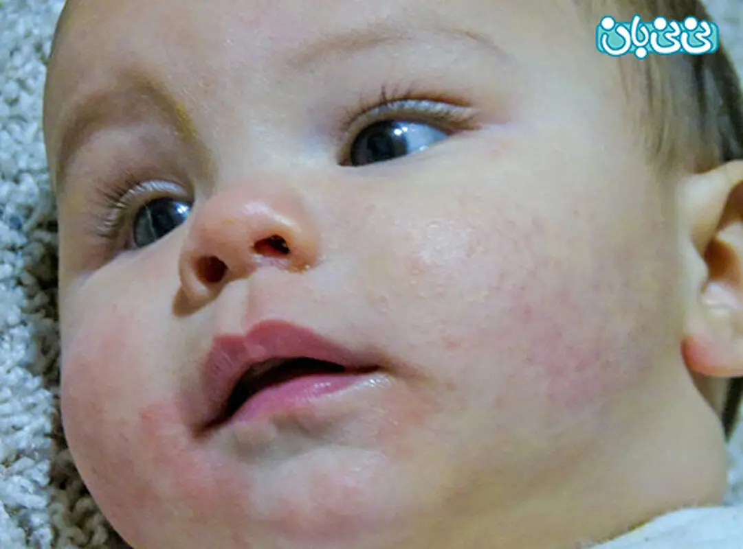 لکه های قرمز پوست کودک، اگزما است؟