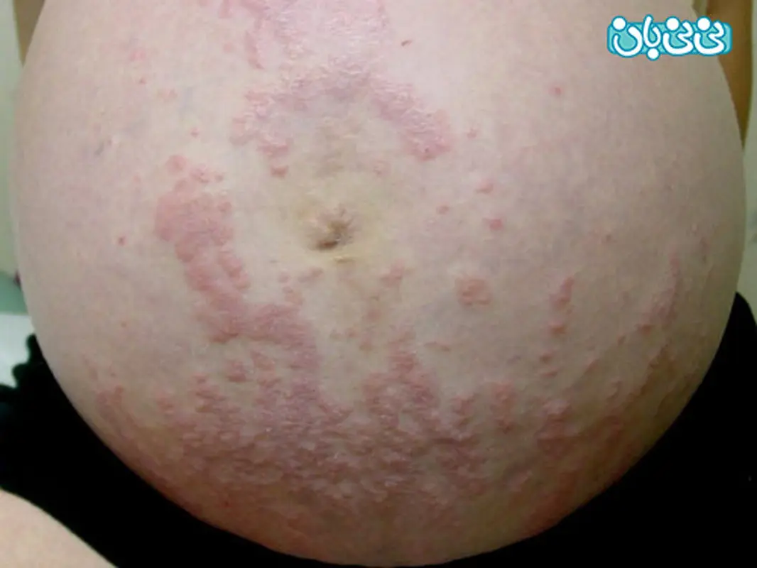 پاپول و پلاک های کهیری خارش دار حاملگی چیست؟