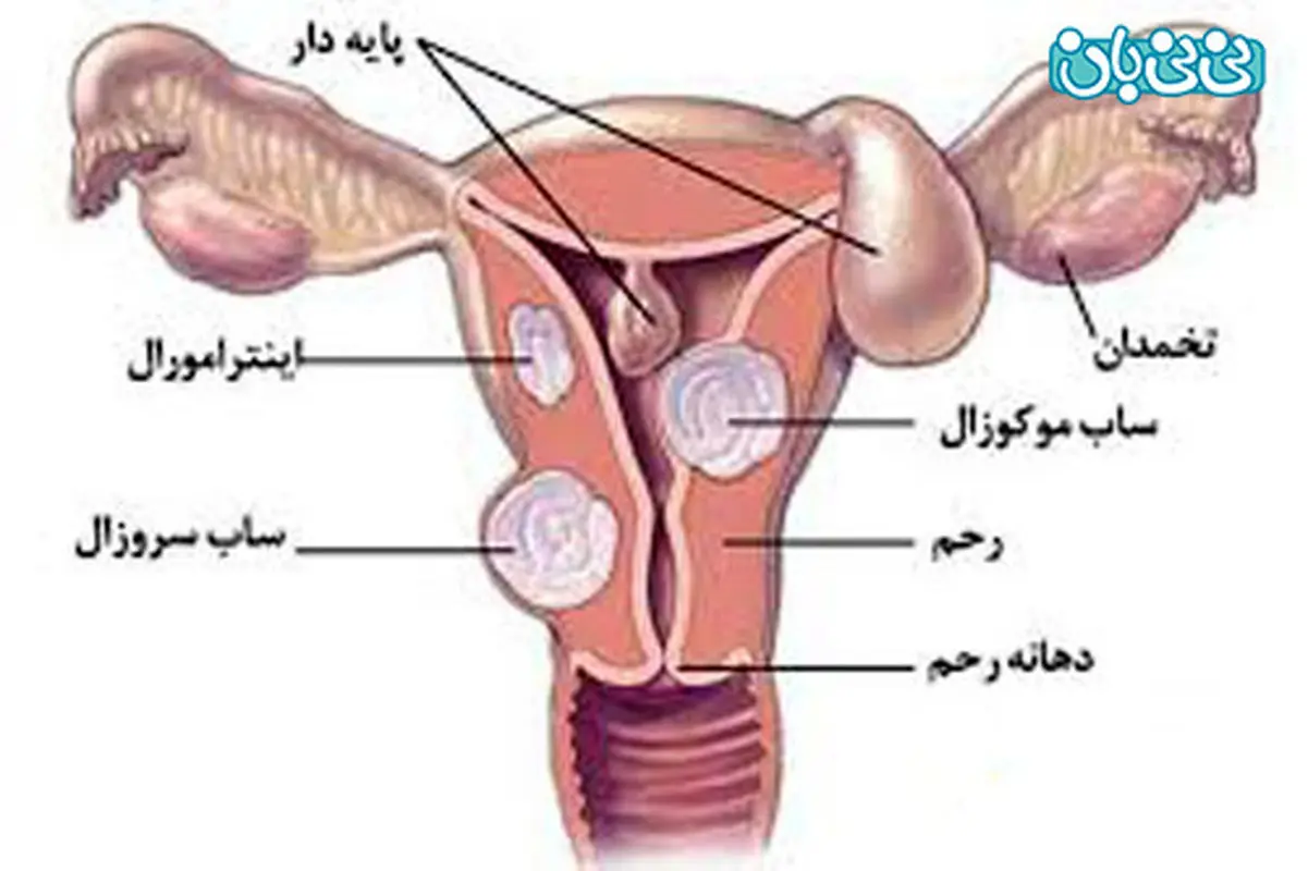 همه چیز درباره فیبروم در بارداری
