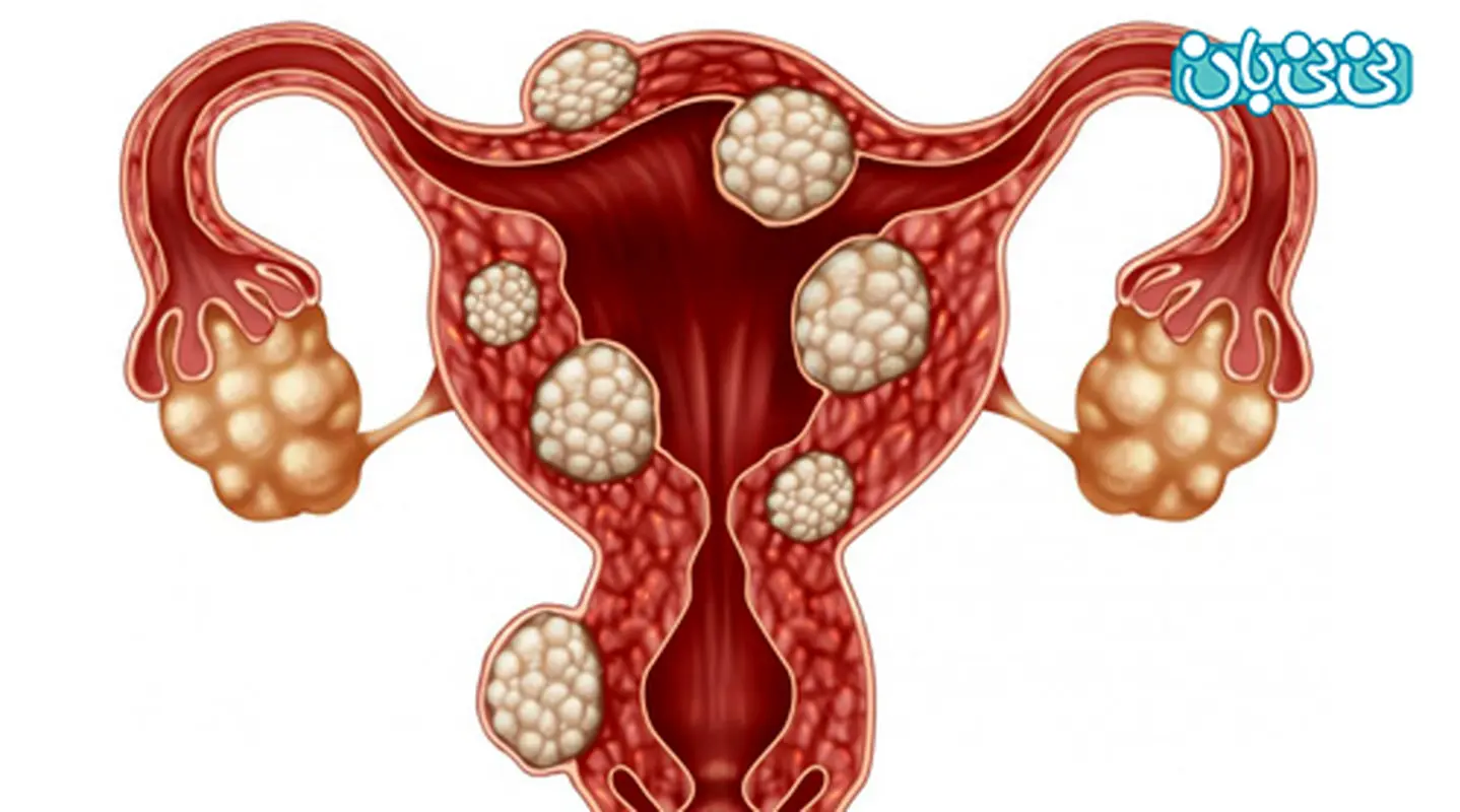 میوم رحمی چیست و چه علایمی را ایجاد مى کند؟