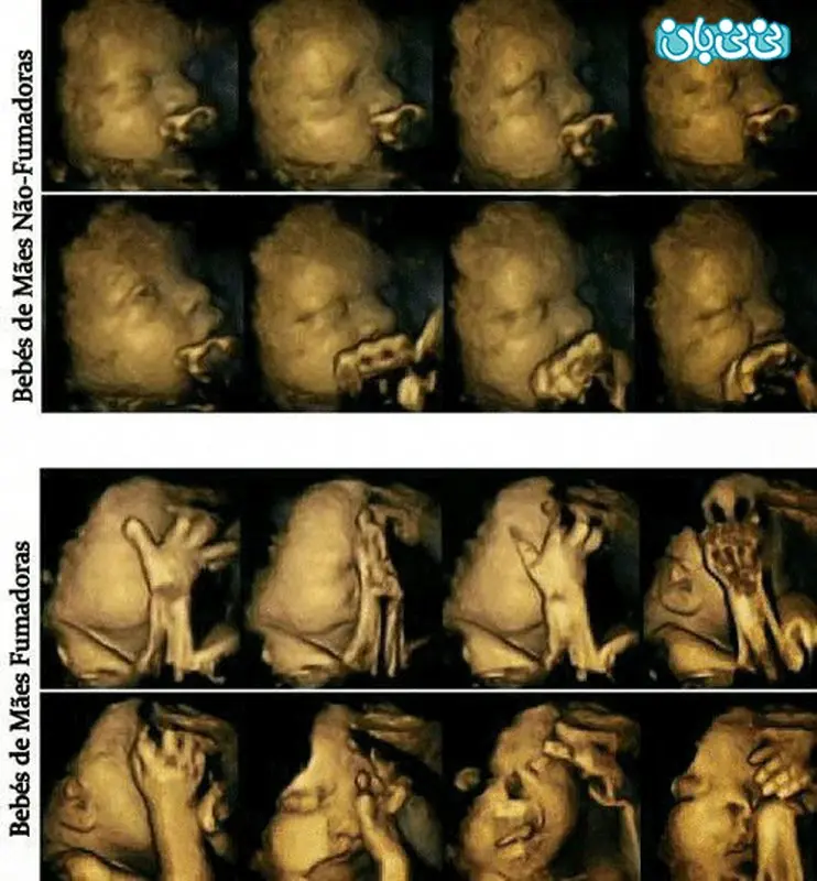 تاثیر سیگار بر روی جنین، تصاویر تکان دهنده