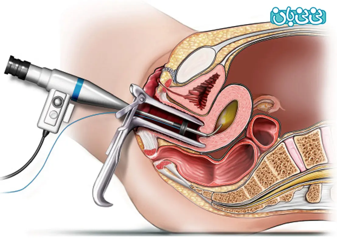 هیستروسکوپی کنم تا چند ماه باردار نمی شوم؟