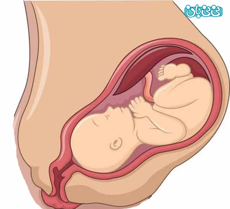 از وضعیت جفت خلفی چه می دانید؟