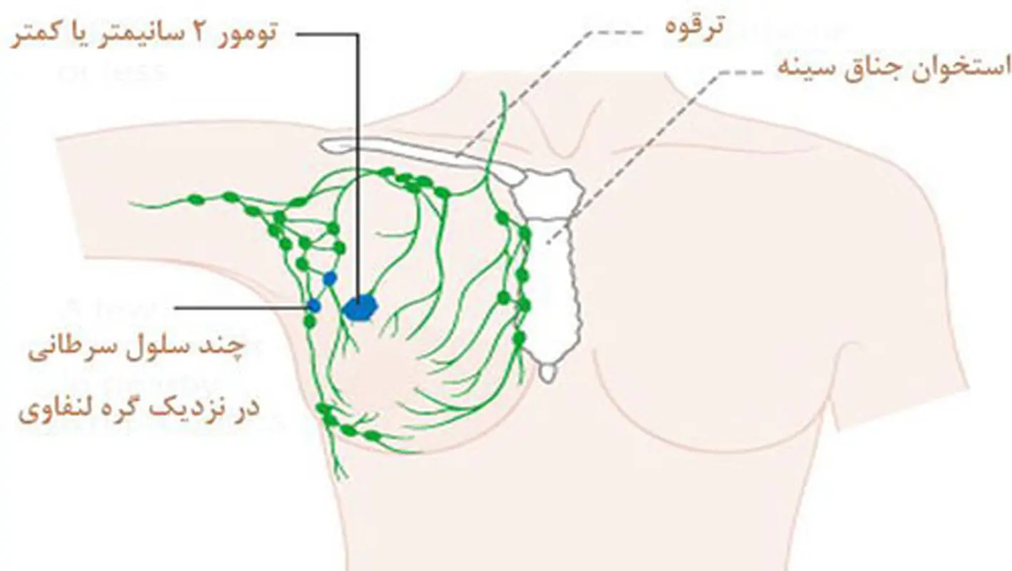 توده زیر بغل زنان،  نشانه سرطان است؟