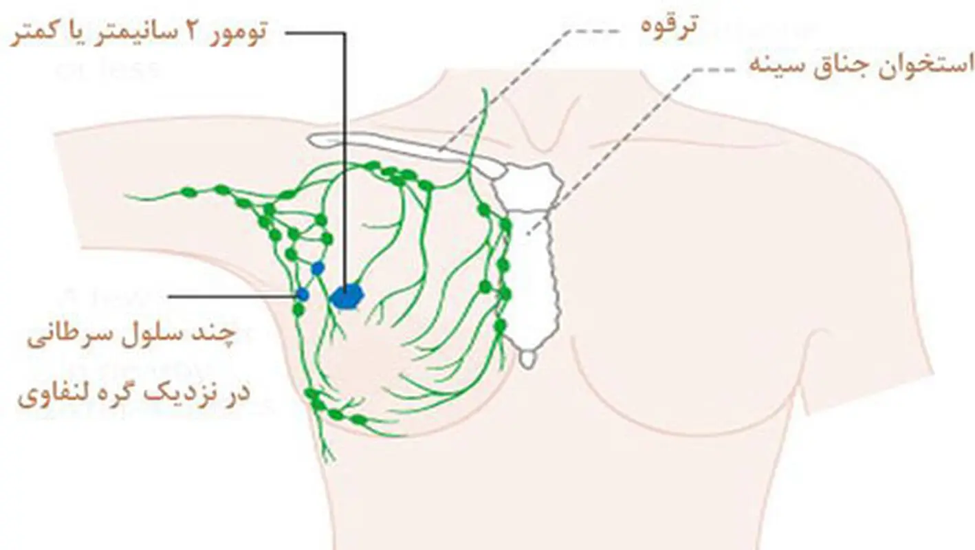 توده زیر بغل زنان،  نشانه سرطان است؟