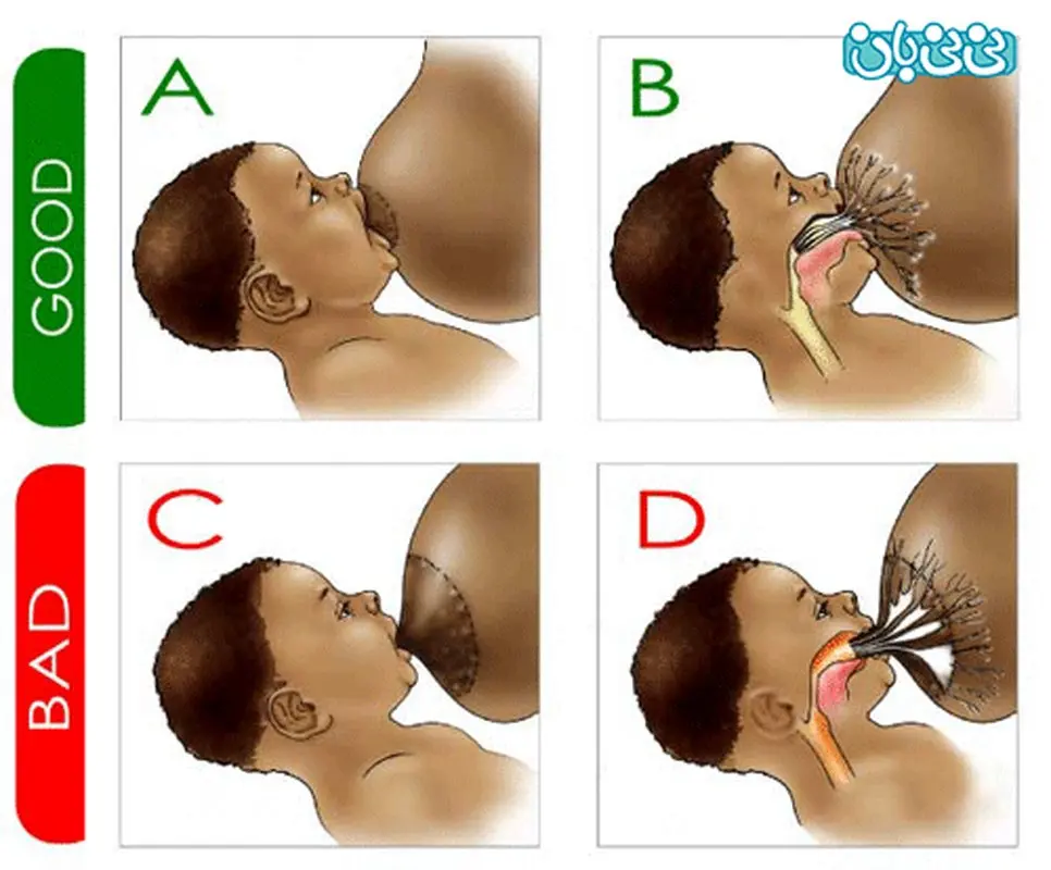 درد نوک سینه در شیردهی، درمان
