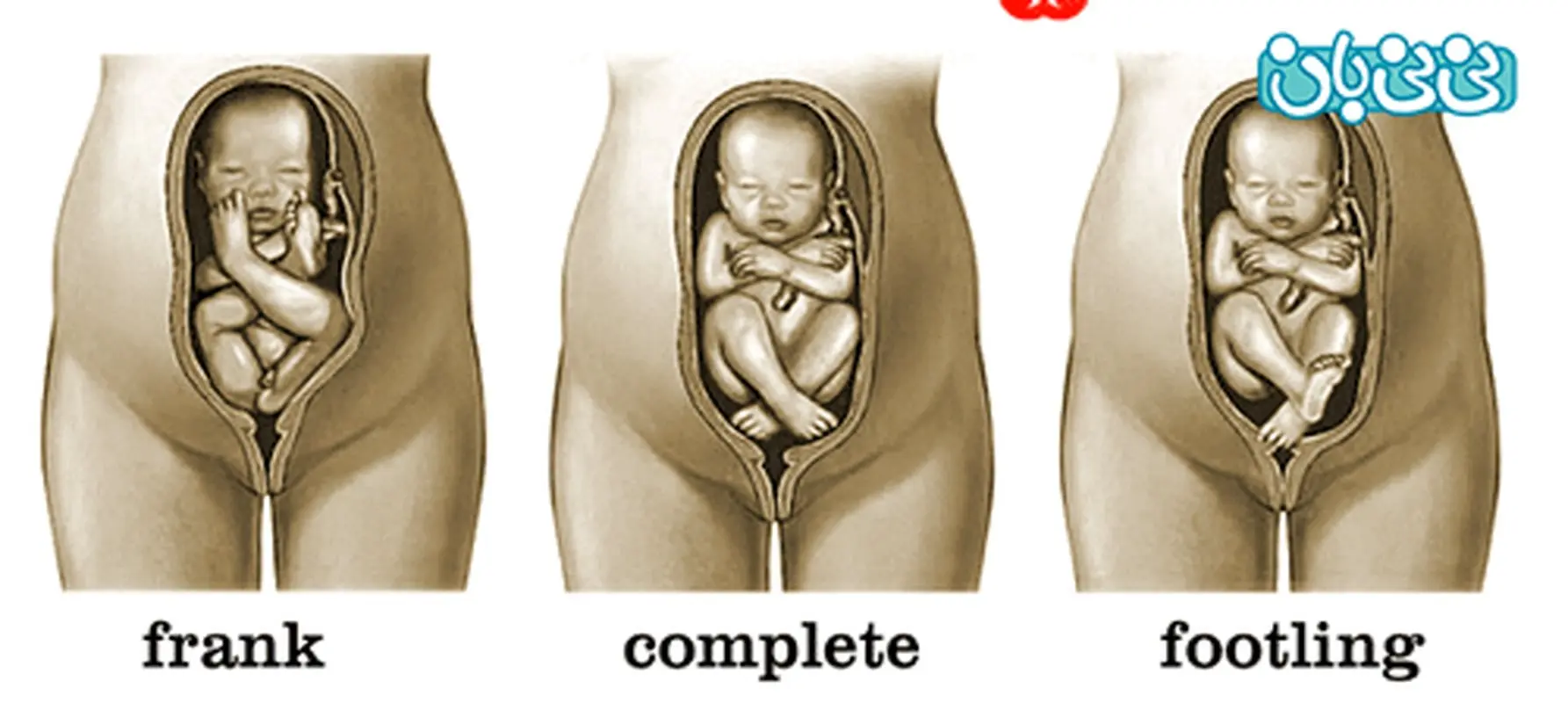 بریج در زایمان، برای نوزاد خطرناکه؟