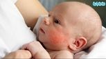 حساسیت پوستی در کودکان، آلرژی های مهم و راه درمان فوری و قطعی