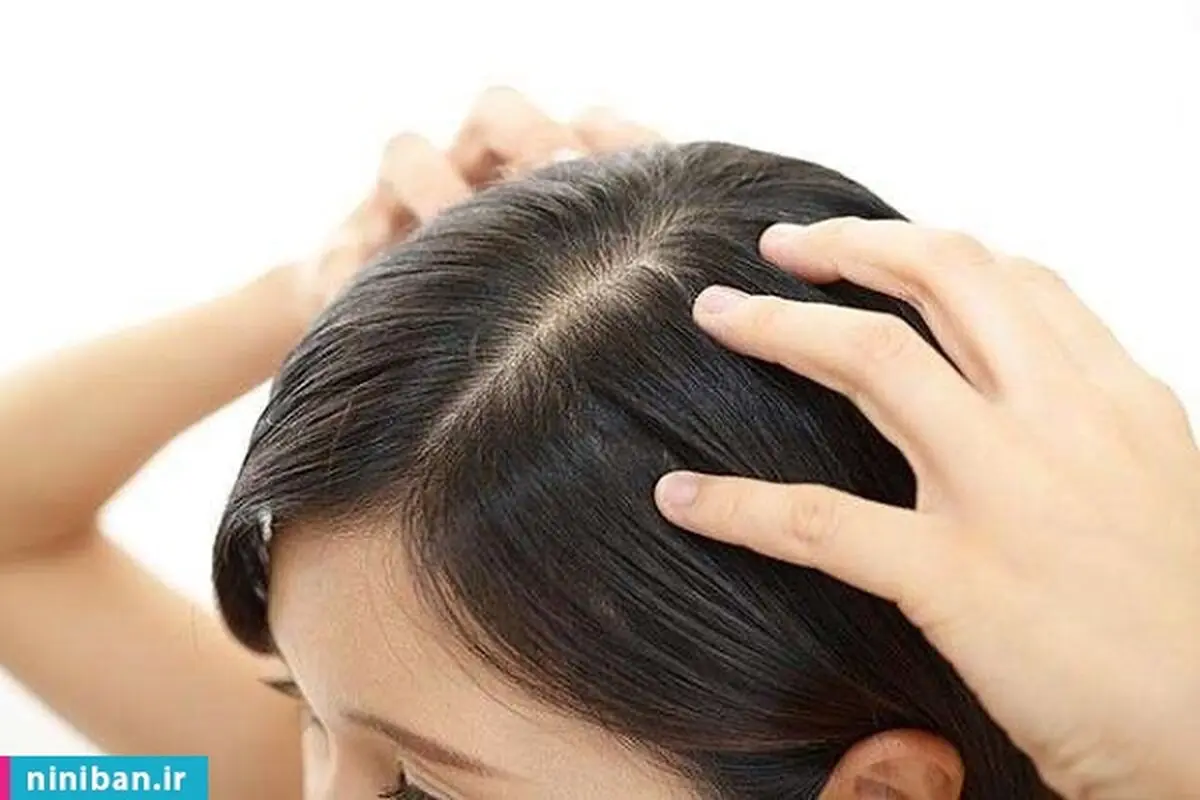 قرص ضد بارداری، برای درمان ریزش مو؟