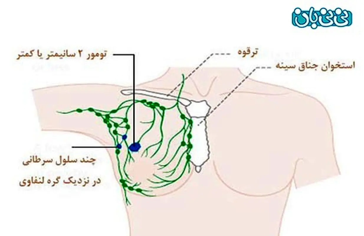 توده زیر بغل، کی خطرناک است؟