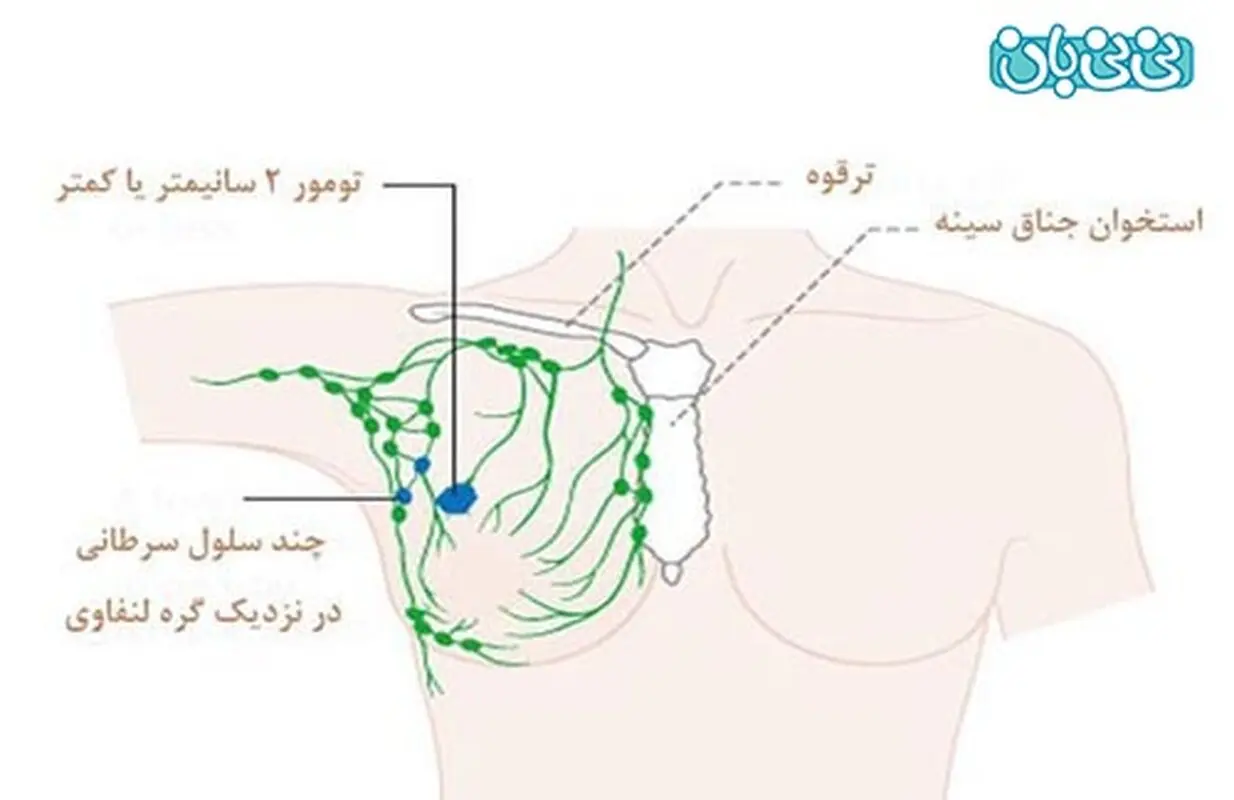 توده زیر بغل، کی خطرناک است؟
