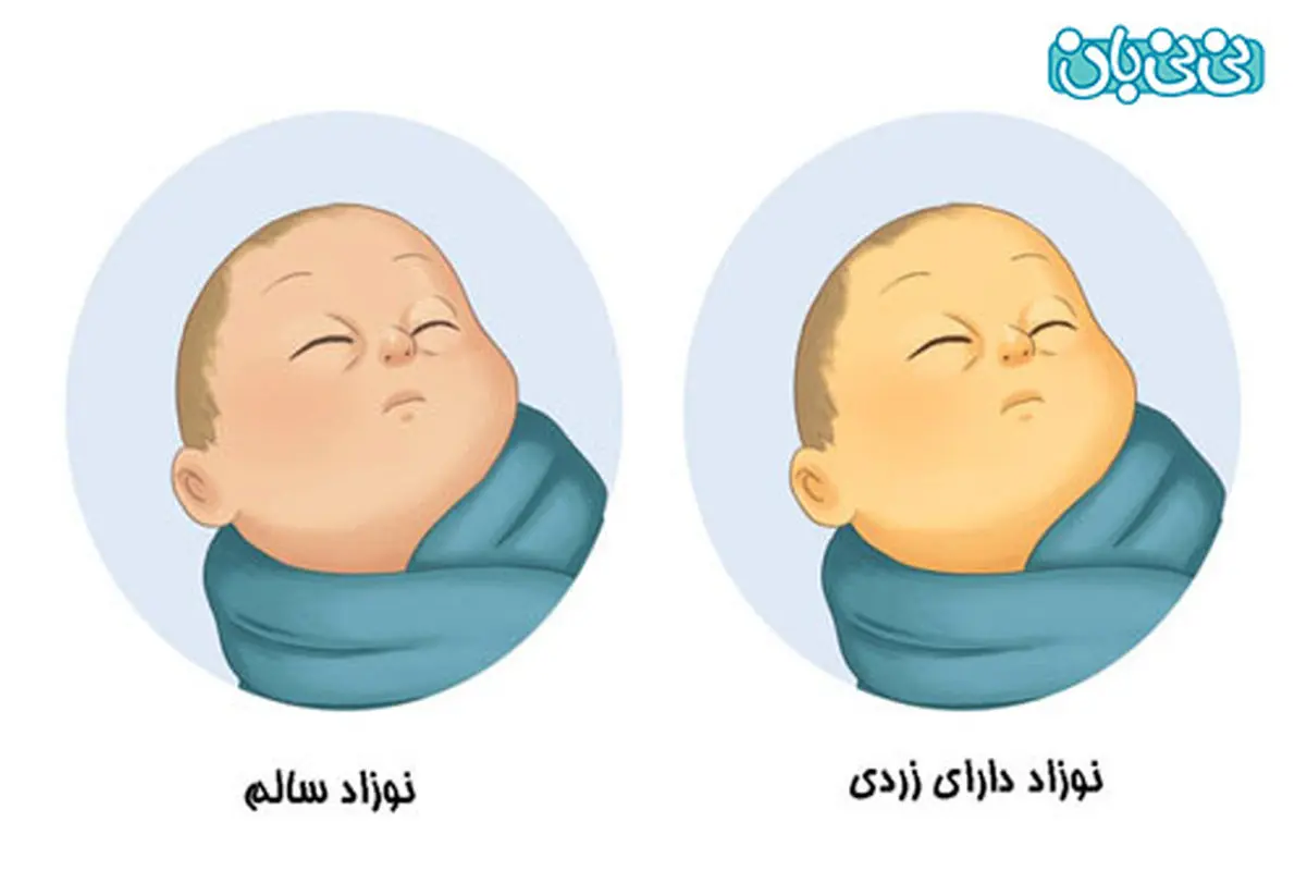 زردی نوزاد، حتی چهل روز؟