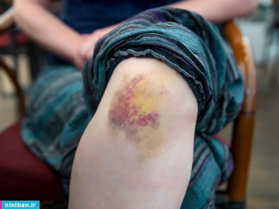 علت کبودی بدن کودکان، نشانه ای از بیماری خونی