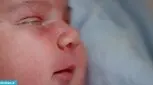 قی کردن چشم نوزادان، درمان
