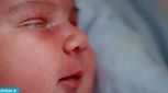قی کردن چشم نوزادان، درمان