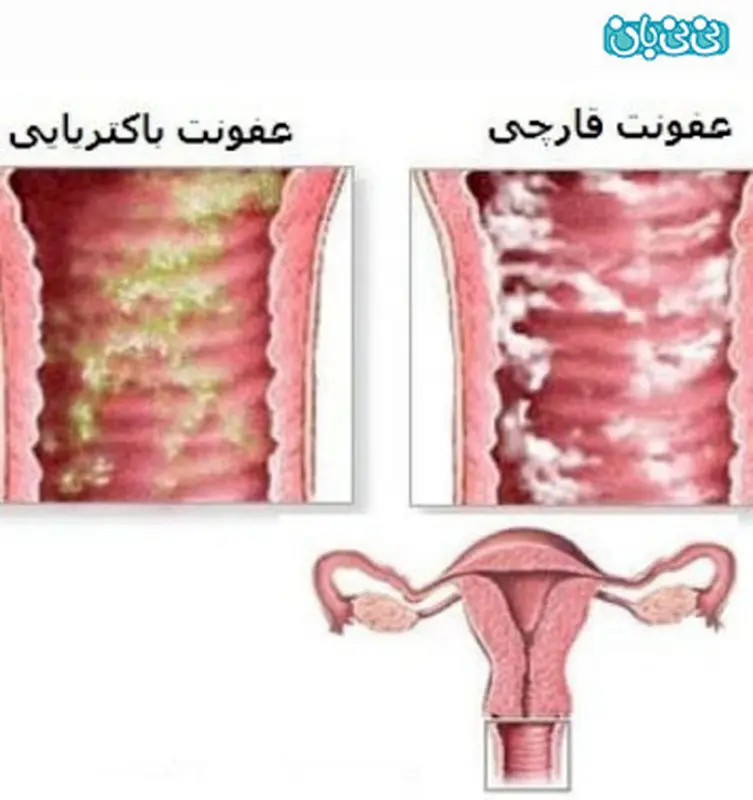 پماد کلوتریمازول در بارداری،‌ مفید یا مضر؟