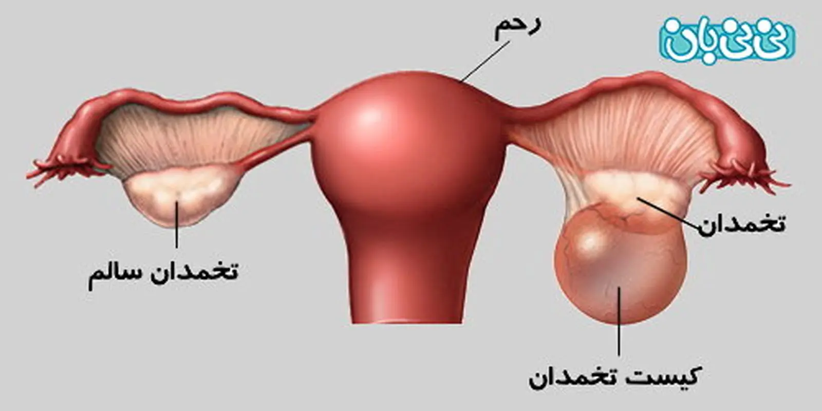 درمان فولیکول تخمدان، با دارو