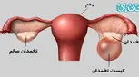 درمان فولیکول تخمدان، با دارو