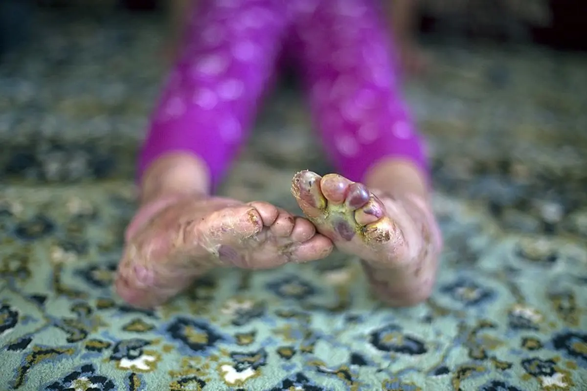 علت بیماری پروانه ای چیست؟