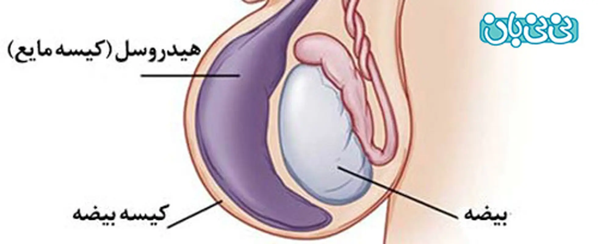 هیدروسل بیضه در نوزادان، بیشتر بدانید