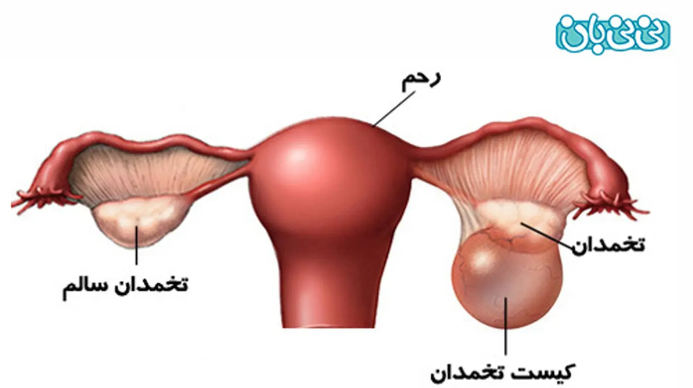 کیست تخمدان چگونه دفع می شود؟