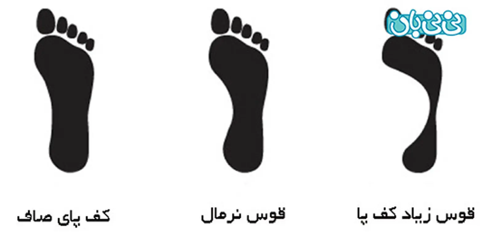 صافی کف پای کودکان، عارضه‌ای مهم