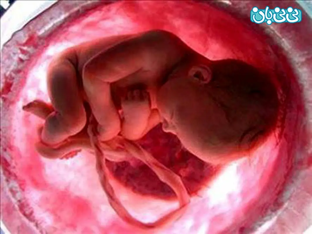 درمان سقط جنین مکرر، چیست؟