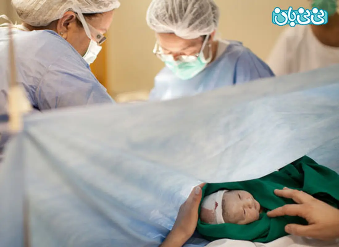چگونگی کاهش عوارض سزارین