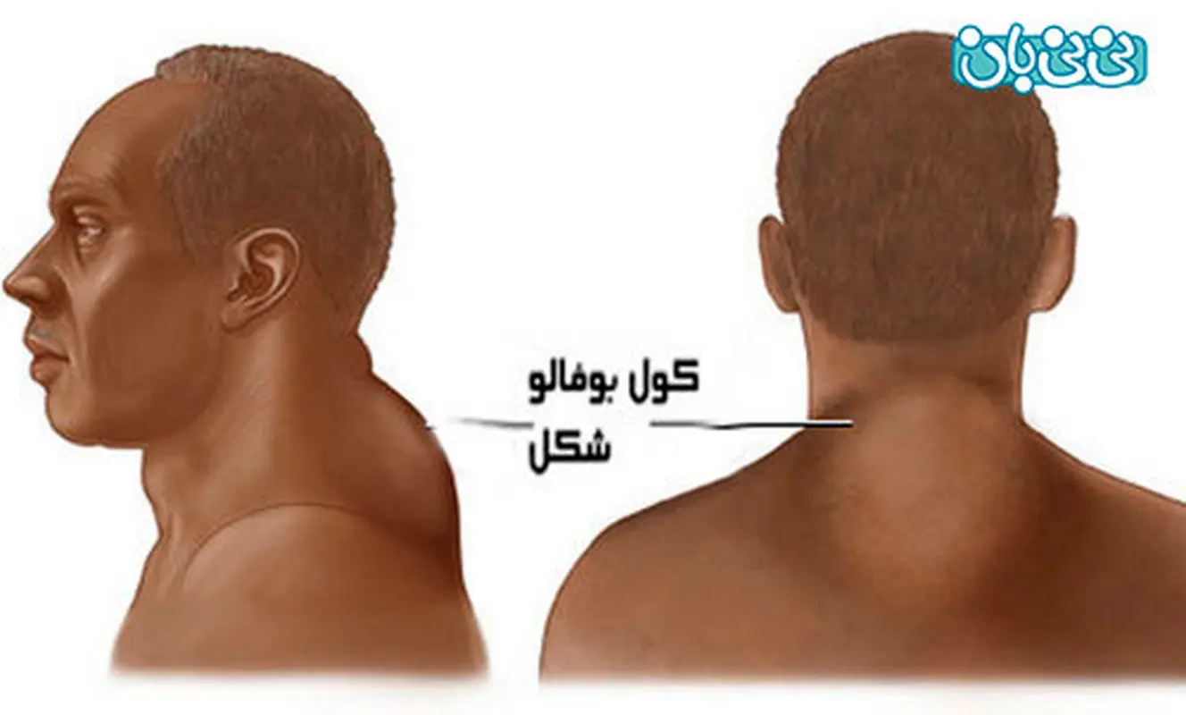 علائم سندروم کوشینگ، قابل توجه آقایان